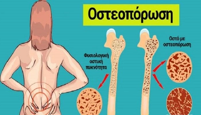 13 τρόποι για να σταματήσετε την οστεοπόρωση και να ενισχύσετε τα οστά σας!